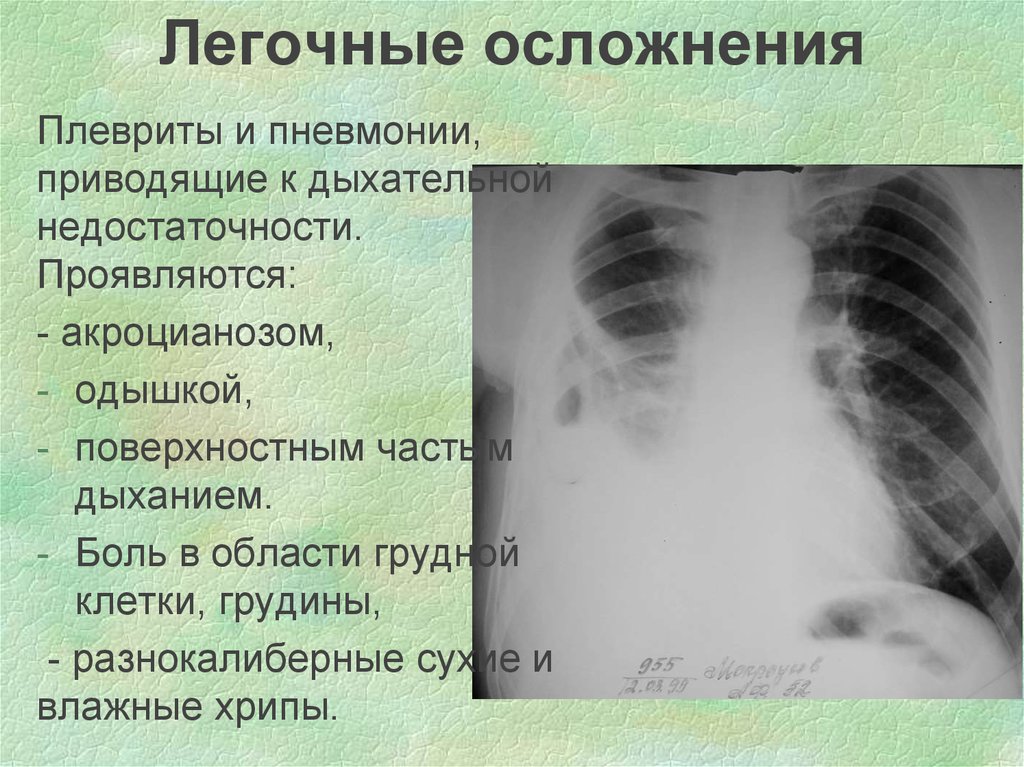 Осложнения после пневмонии у детей. Легочные осложнения пневмонии. Плеврит осложнение пневмонии. Легочно плевральные осложнения. Пневмония осложненная плевритом.