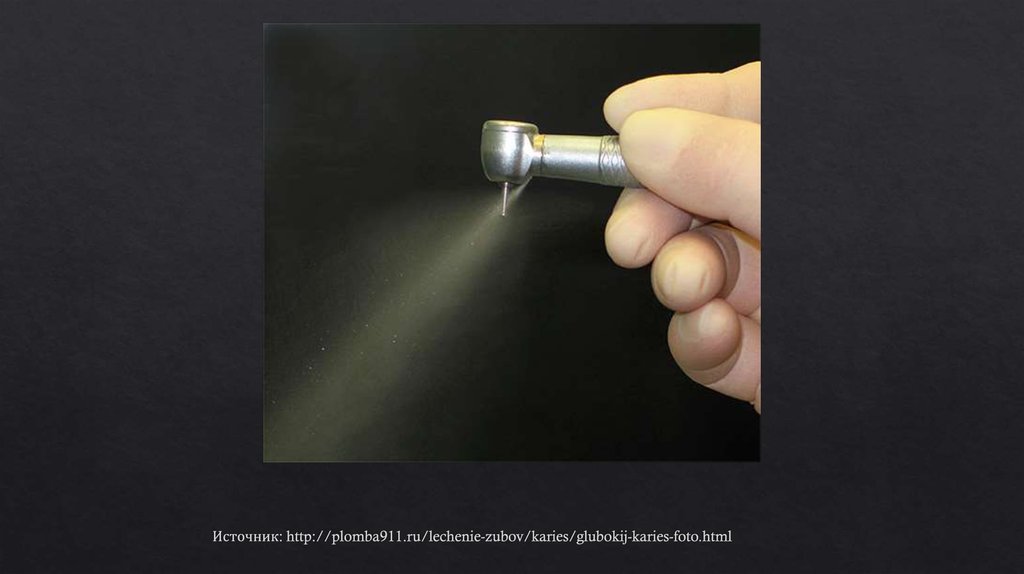 Источник: http://plomba911.ru/lechenie-zubov/karies/glubokij-karies-foto.html