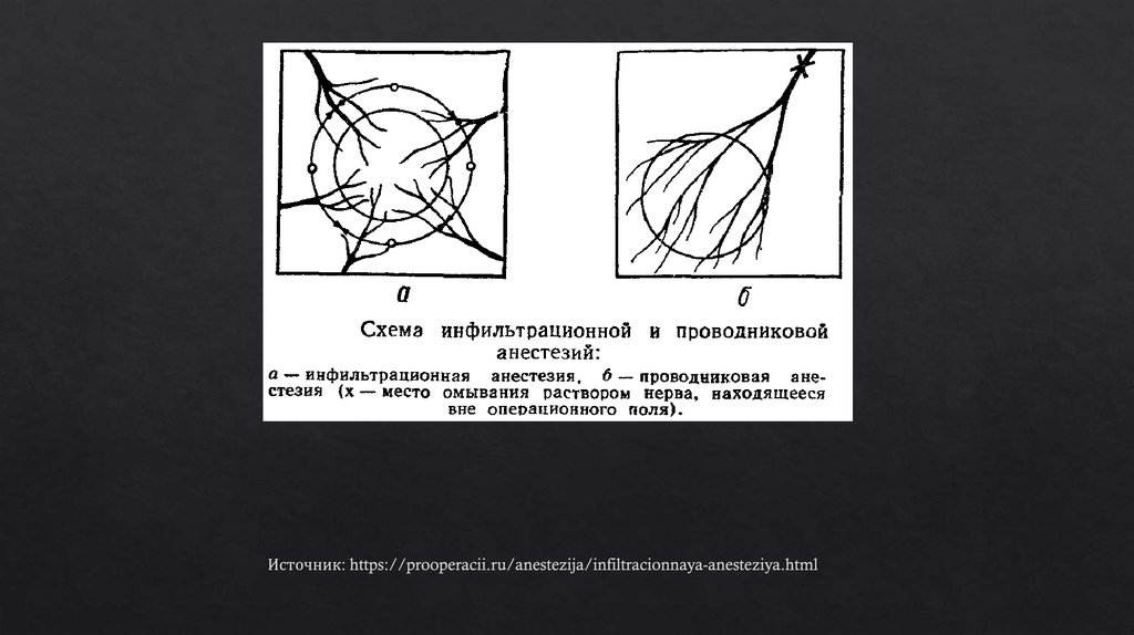 Источник: https://prooperacii.ru/anestezija/infiltracionnaya-anesteziya.html