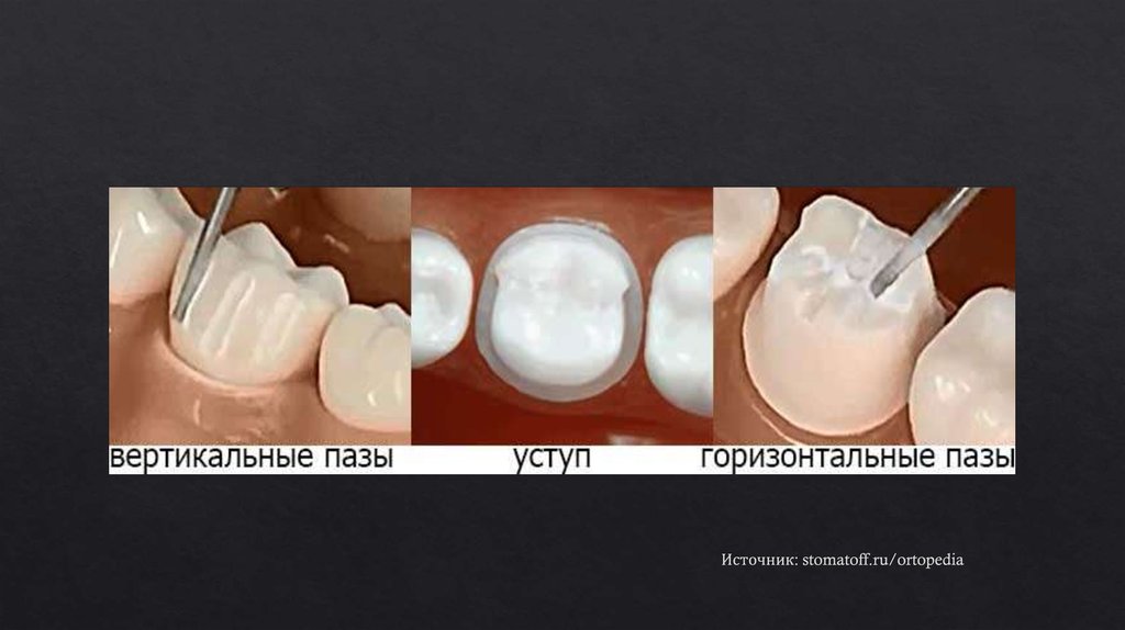 Источник: stomatoff.ru/ortopedia