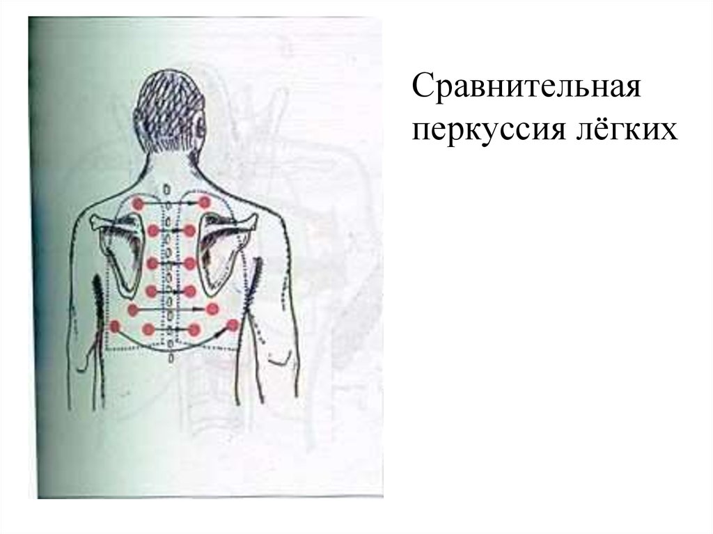 Сравнительная перкуссия. Точки сравнительной аускультации и перкуссии легких. Сравнительная перкуссия сердца аускультация. Сравнительная аускультация легких. Точки сравнительной аускультации и перкусси лёгких.