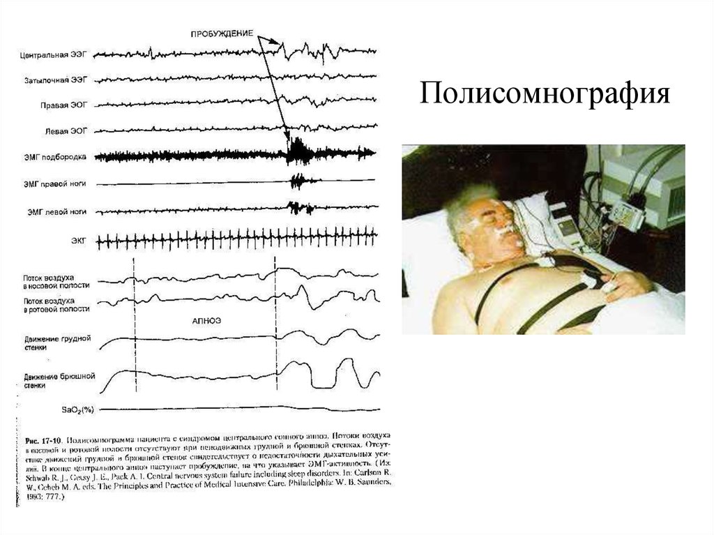 Полисомнография. Полисомнографическое исследование. Стационарная полисомнография.