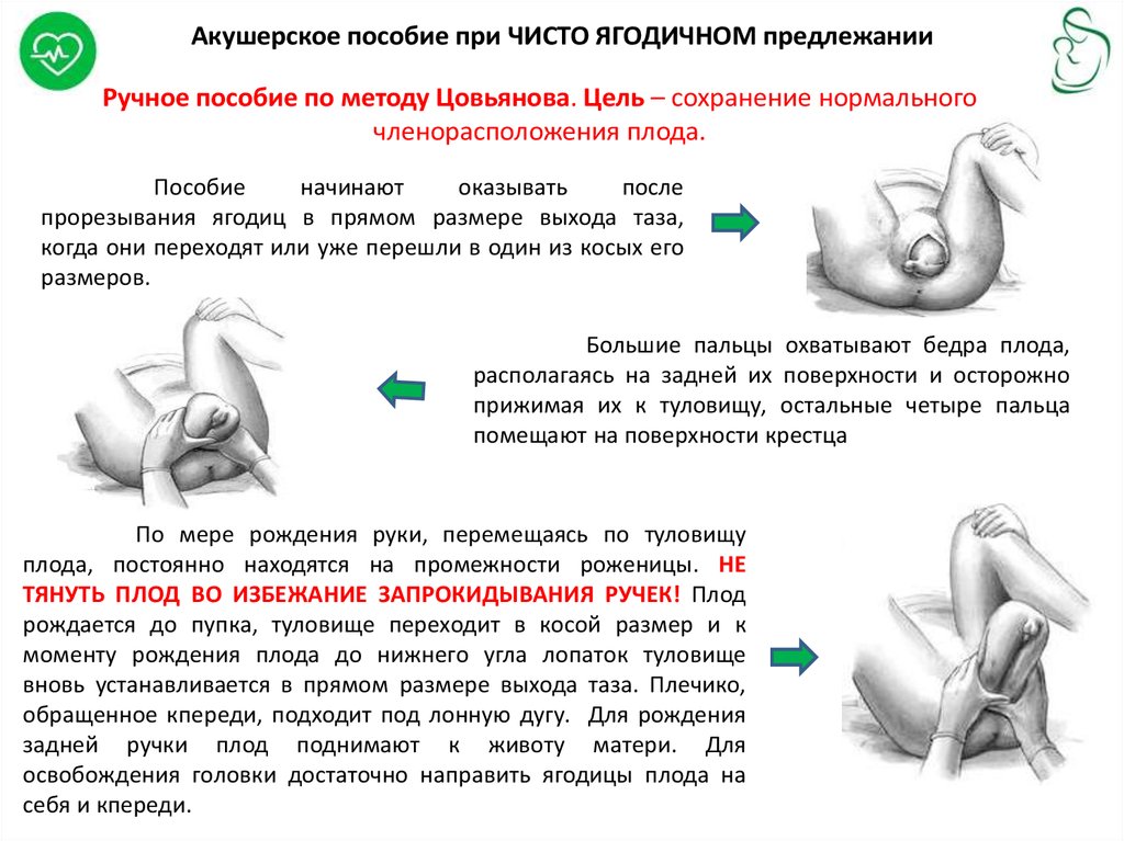 Акушерское пособие. Пособие при ягодичном предлежании. Оказание пособия по Цовьянову при чисто ягодичном предлежании. Ручное пособие по Цовьянову при чисто ягодичном. Пособие по Цовьянову при тазовом предлежании плода.