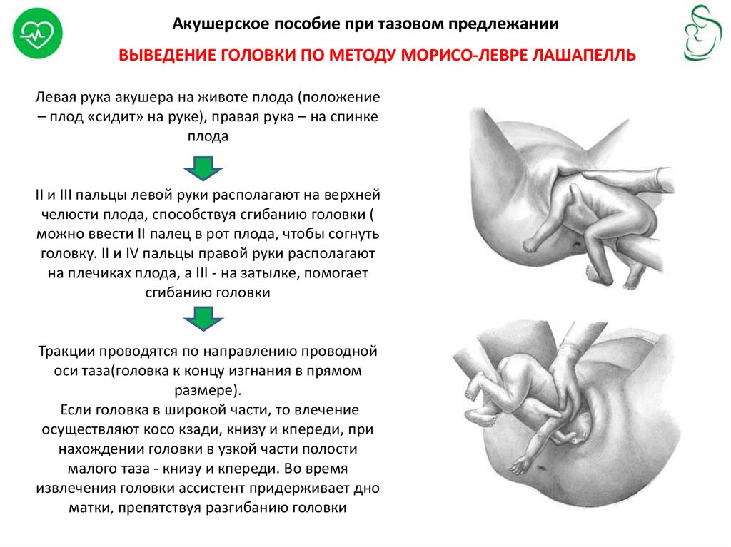 Тазовое предлежание показание. Ручное пособие при тазовом предлежании. Акушерское пособие при тазовом предлежании алгоритм. Ручное акушерское пособие при тазовом предлежании. Ручное акушерское пособие при ягодичном предлежании.