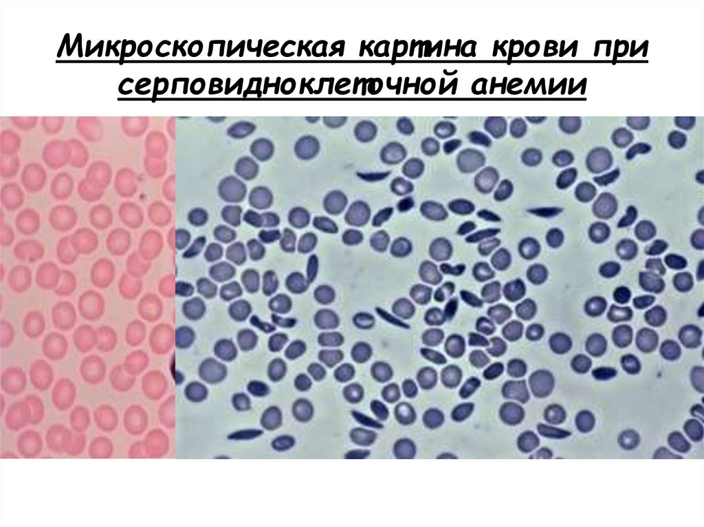 Картина крови при анемии