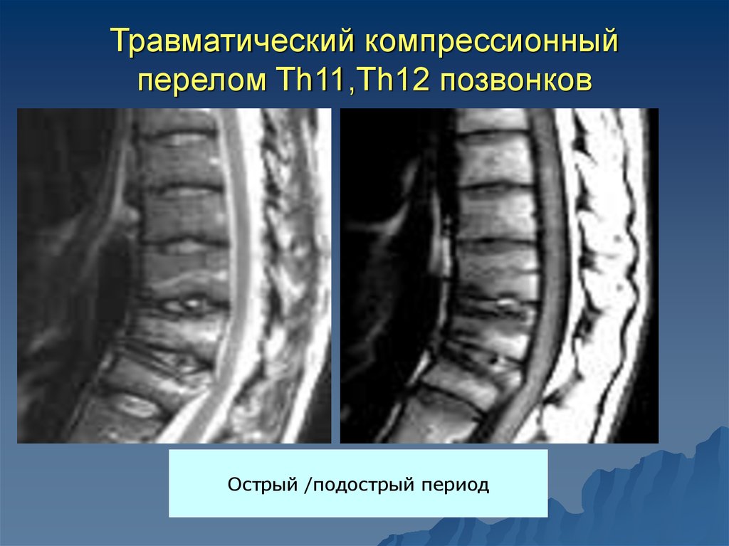 Перелом грудных позвоночников. Компрессионный перелом позвоночника th11. Компрессионный перелом th12 позвонка. Компрессия тела позвонка th12. Компрессионный перелом позвоночника th12 l3.