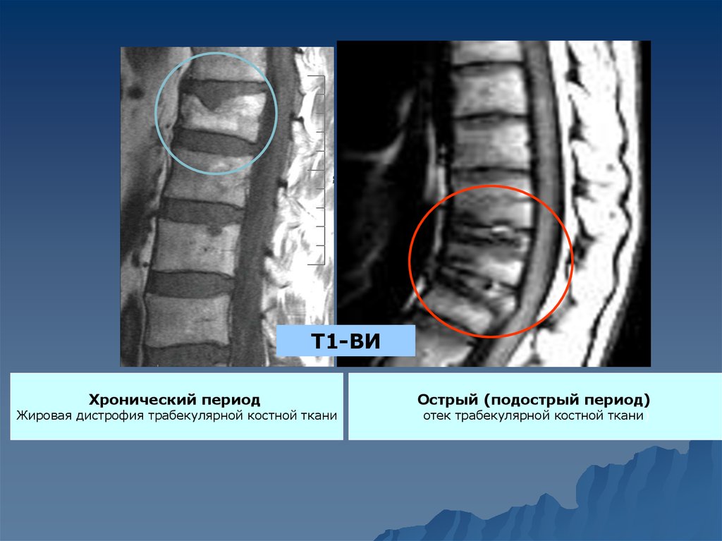 Отек костного мозга позвоночника поясничного отдела что. Трабекулярный отек костного мозга. Трабекулярный отёк позвонков. Трабекулярный перелом.