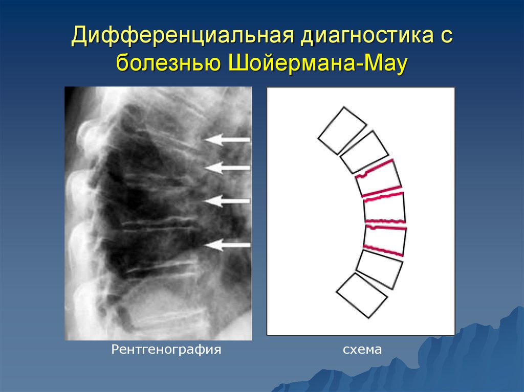 Болезнь шейермана по утвержденным клиническим рекомендациям. Шойерман-МАУ болезнь рентгенологические. Остеохондропатия Шейерман-МАУ. Болезнь Шейермана МАУ рентген.