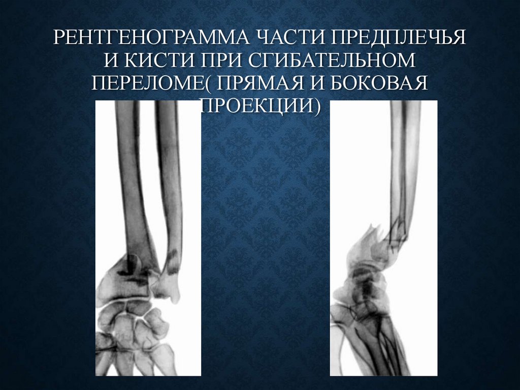 Рентгенограмма части предплечья и кисти при сгибательном переломе( прямая и боковая проекции)