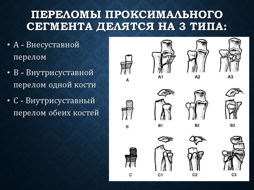 Перелом предплечья травматология презентация