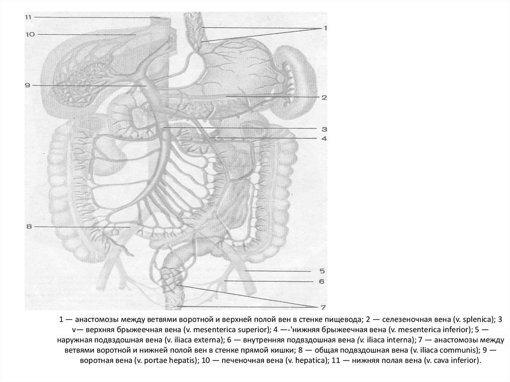 Анастомозы передней брюшной стенки. Верхняя нижняя воротная Вена. Верхняя брыжеечная Вена. Верхняя селезеночная Вена. Схема портокавальных анастомозов пищевода.