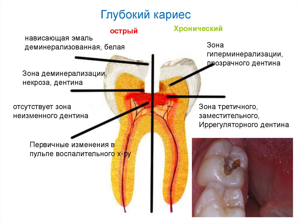 Онихомадезис фото и лечение