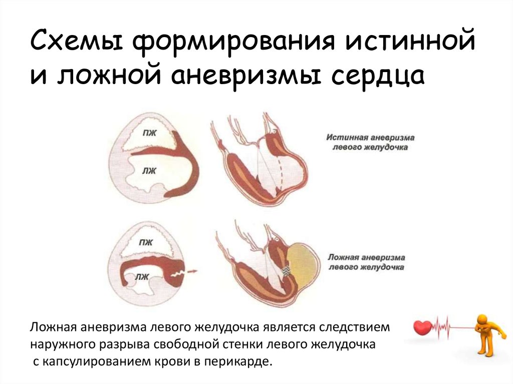 Схемы формирования истинной и ложной аневризмы сердца Ложная аневризма левого желудочка является следствием наружного разрыва