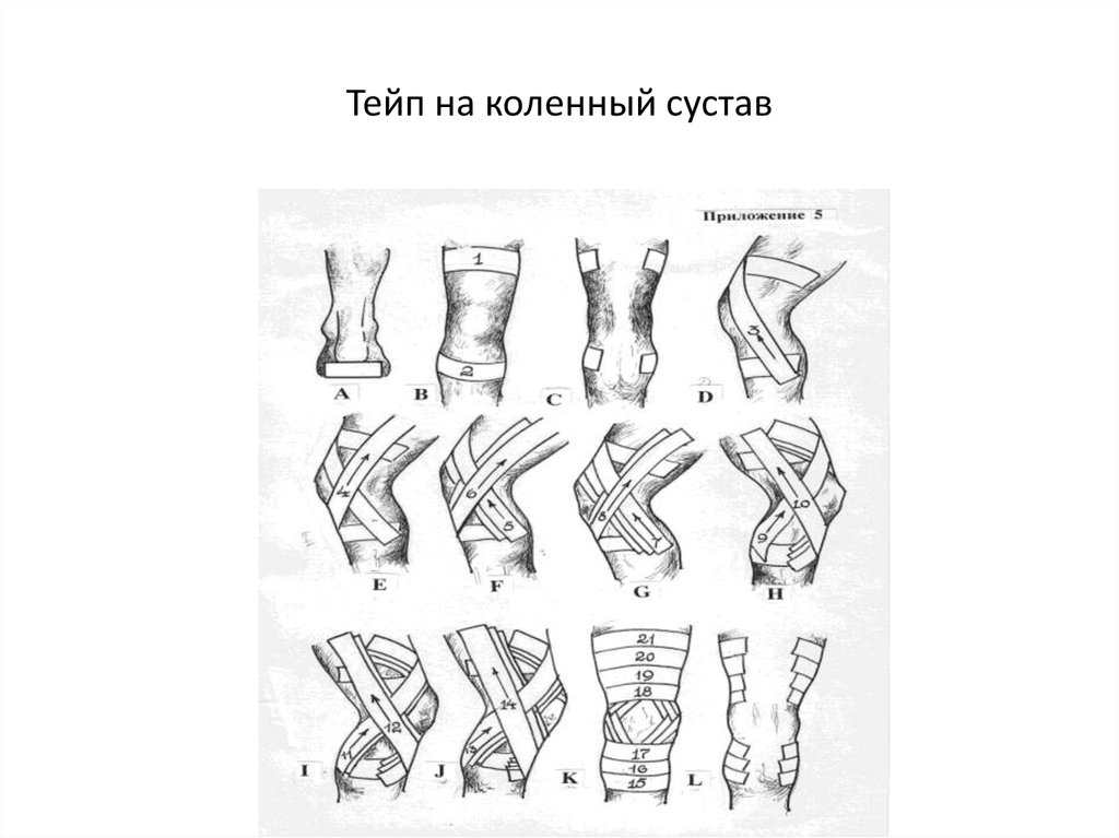 Тейпирование коленного сустава для бега схема