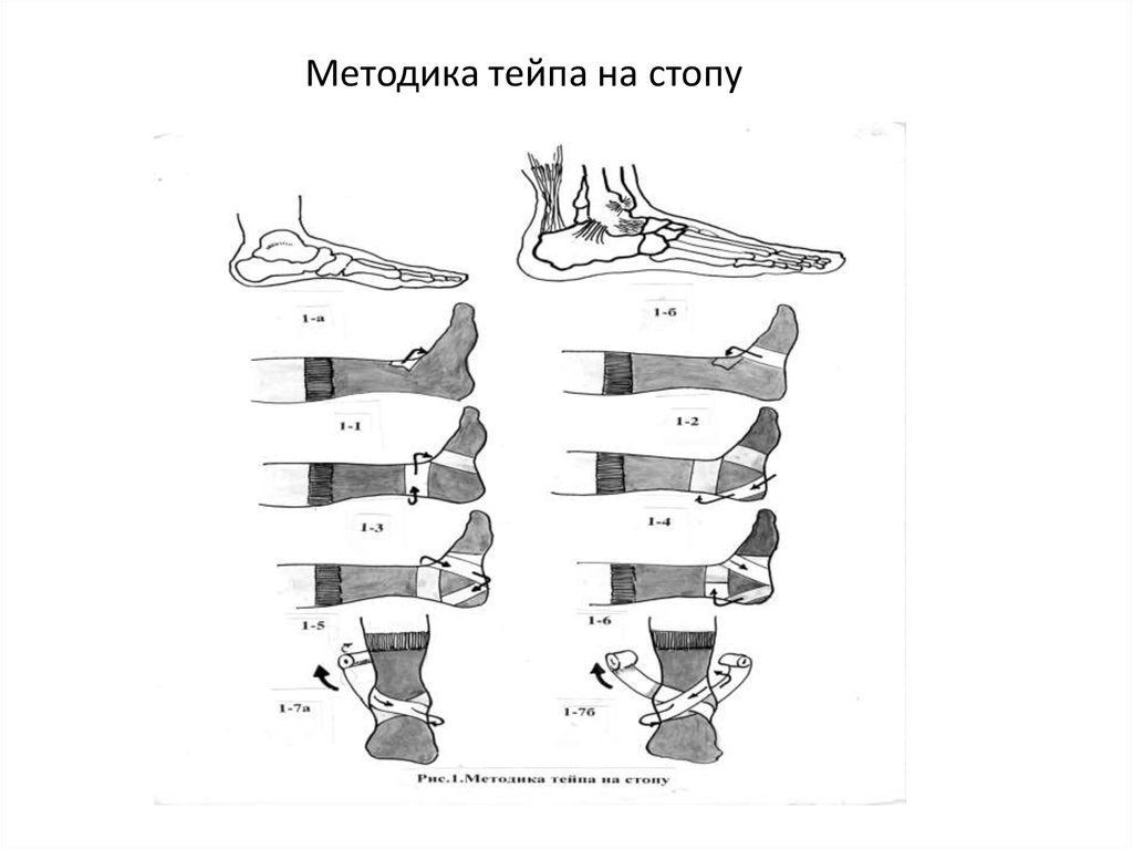 Тейпы при растяжении голеностопа схема