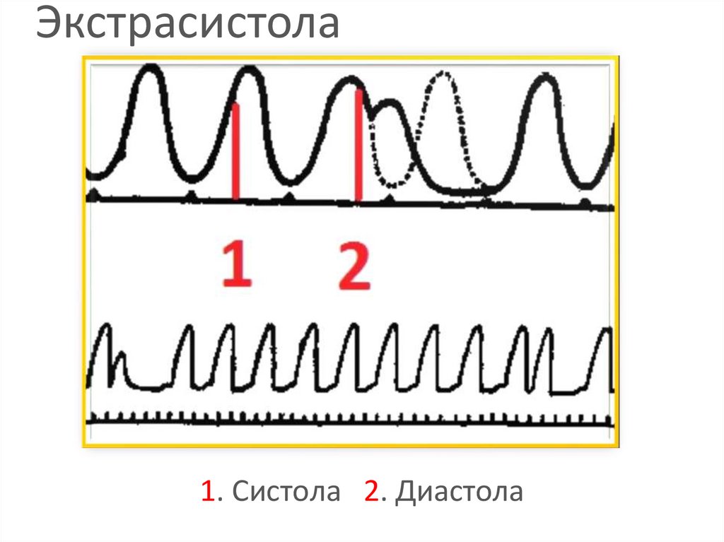 Экстрасистола это. Экстрасистола рисунок. Экстрасистола в диастолу. Систола диастола и экстрасистола. Экстрасистола физиология.