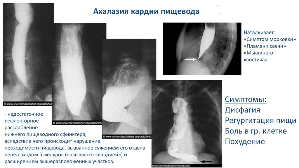 Рентгенологическая картина ахалазии пищевода