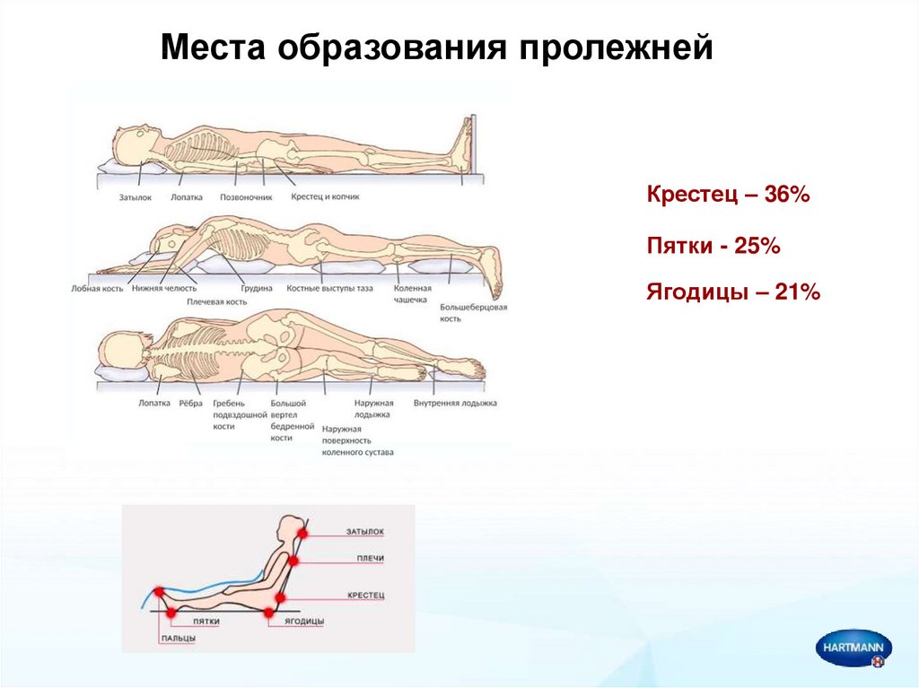 Пролежни профилактика пролежней. Места образования пролежней. Предупреждение образования пролежней. Пролежни их локализация.