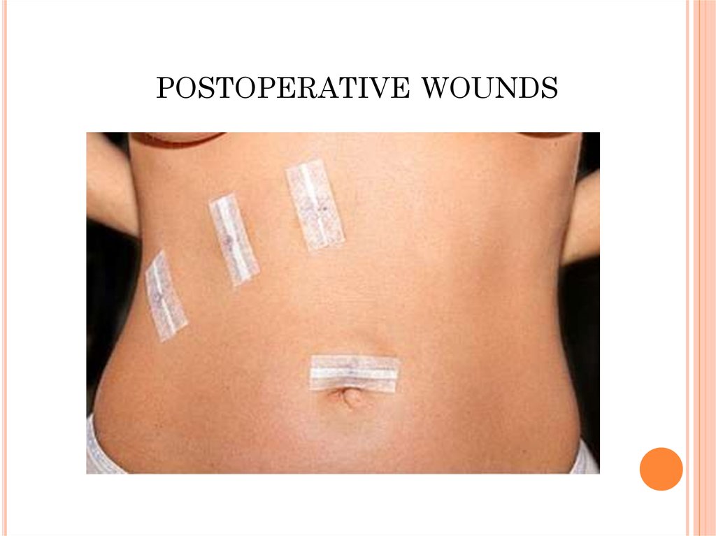 postoperative wounds 