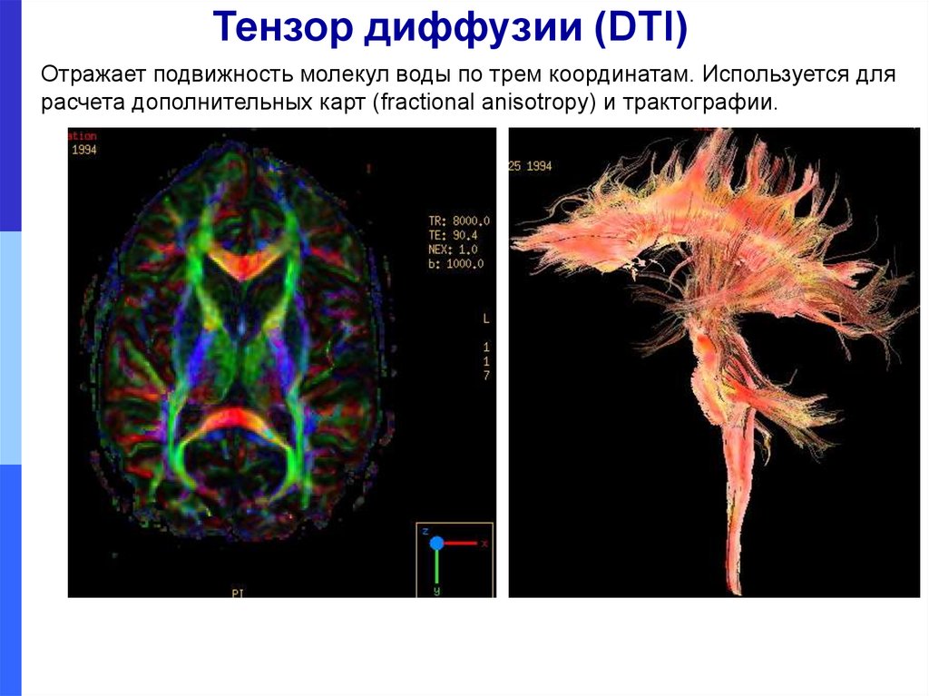 Диффузная головного мозга. Диффузионно-тензорная мрт. Тензорная трактография. Фракционная анизотропия. Диффузионная тензорная визуализация.