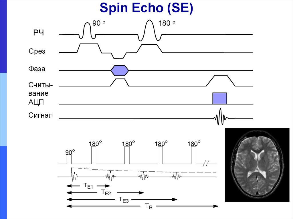 Fast spin. Спин Эхо мрт. Спин Эхо последовательность мрт. Турбо спин Эхо мрт. T1-ви Spin Echo.