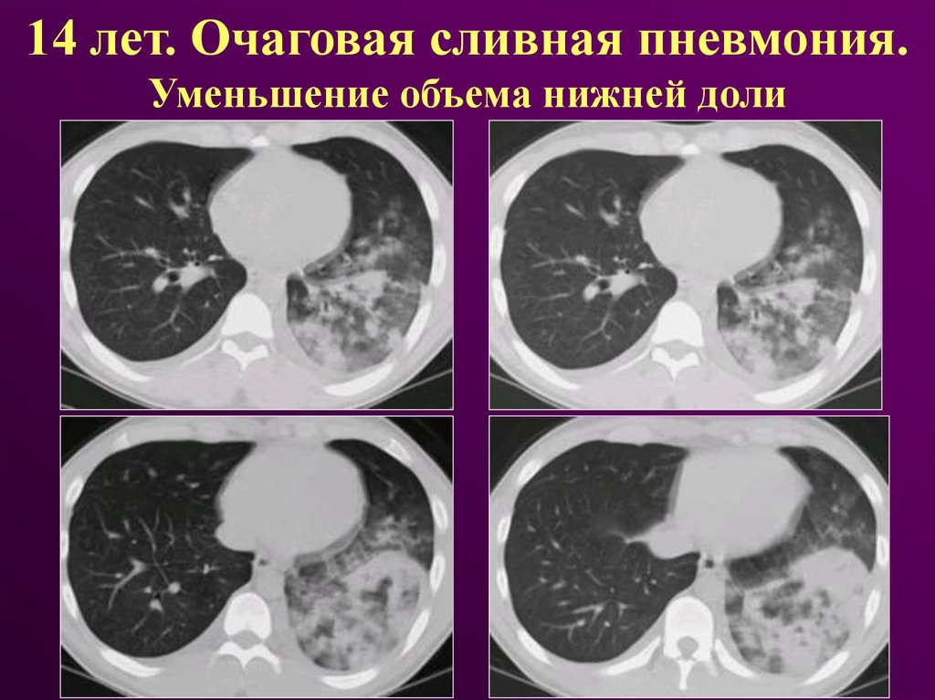 Очаговая пневмония это. Сегментарная сливная пневмония. Очаговая пневмония. Очагово сливная пневмония. Двухсторонняя сливная пневмония.