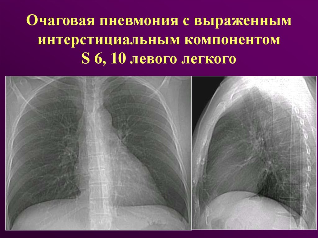 Пневмония 6. Интерстициальная пневмония на рентгенограмме. Рентгенодиагностика интерстициальной пневмонии. Интерстициальная пневмония рентген. Острая интерстициальная пневмония рентген.