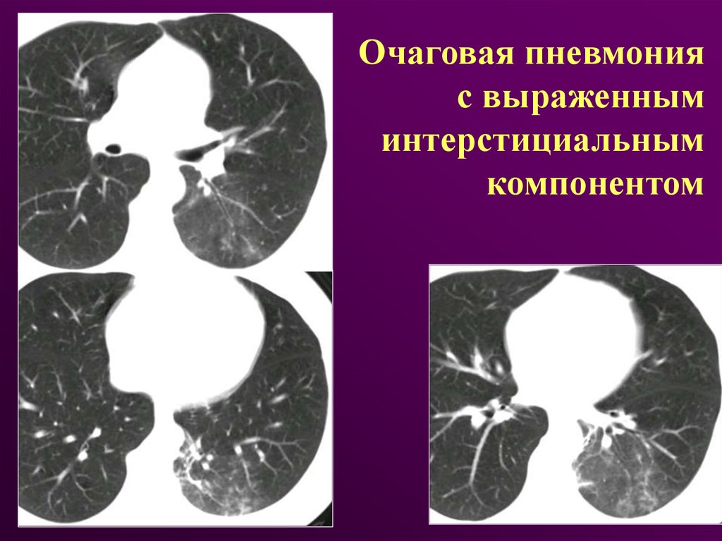 Интерстициальная пневмония. Очаговая бронхопневмония кт. Острая интерстициальная пневмония кт. Интерстициальная пневмония кт. Неспецифическая интерстициальная пневмония кт.