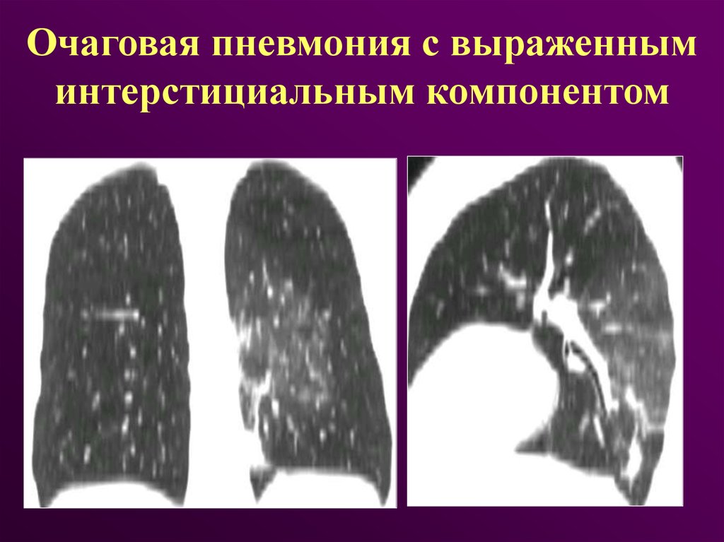 Очаговая пневмония. Острая очаговая пневмония. Рентгенодиагностика пневмонии очаговая. Как выглядит очаговая пневмония.