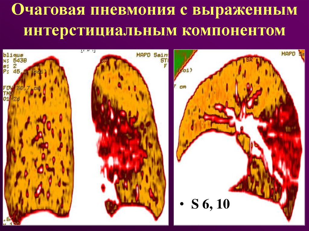 Осложнения очагов пневмонии. Очаговая пневмония. Острая очаговая пневмония. Интерстициальная пневмония и очаговая.