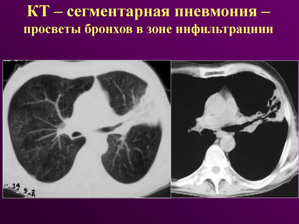 Пневмоцистная пневмония кт картина