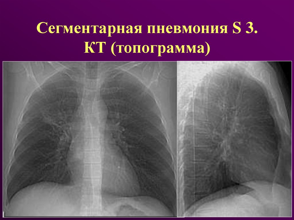 Сегментарная пневмония у детей что это