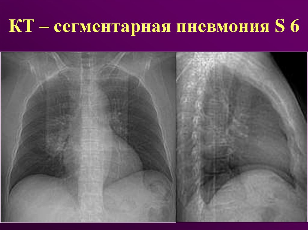 Сегментарная пневмония у детей что это