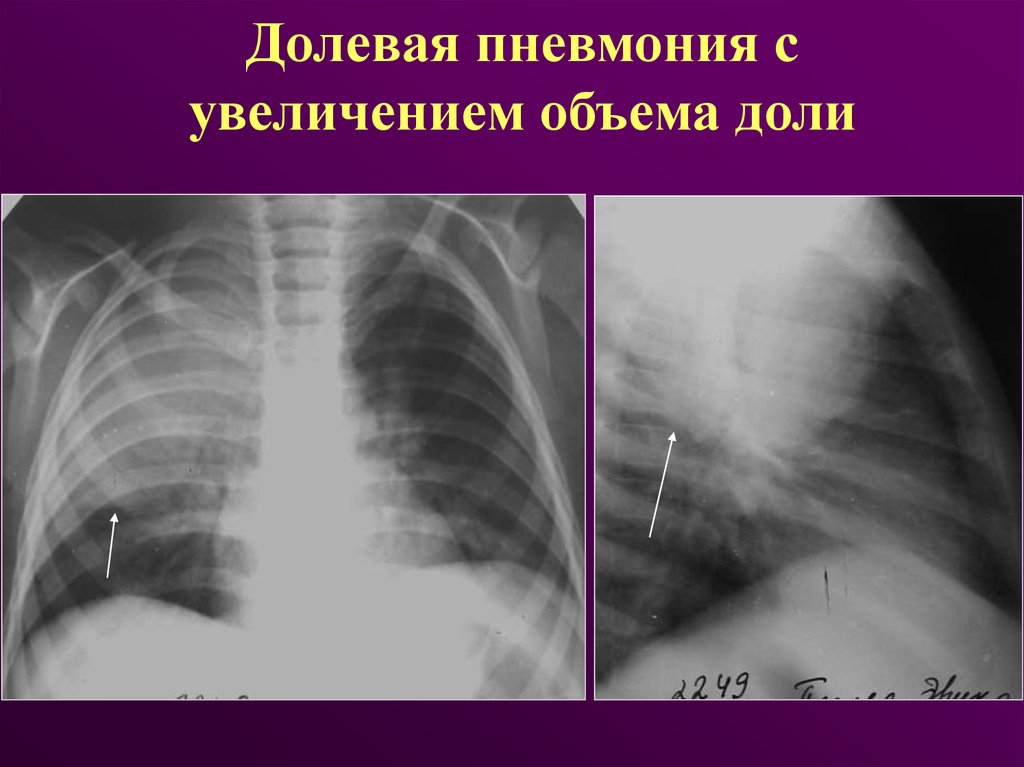Пневмония верхней доли легкого. Долевая пневмония. Долевая пневмония рентген. Двусторонняя долевая пневмония. Рентгенодиагностика острых пневмоний.