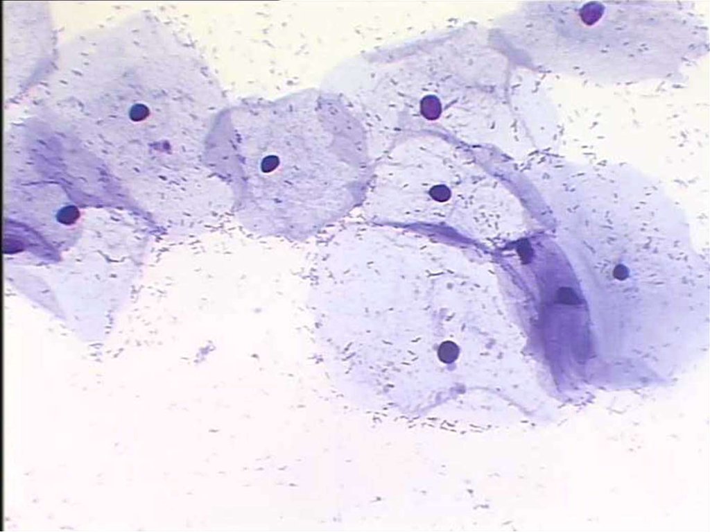 Цитологическая картина воспаления в мазке что это значит у женщин