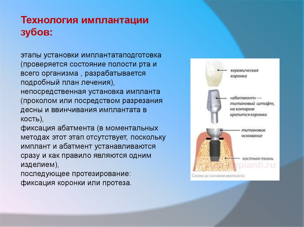 Имплант срок установки. Этапы установки имплантата. Имплантация презентация. Этапы установки импаниа зуб.