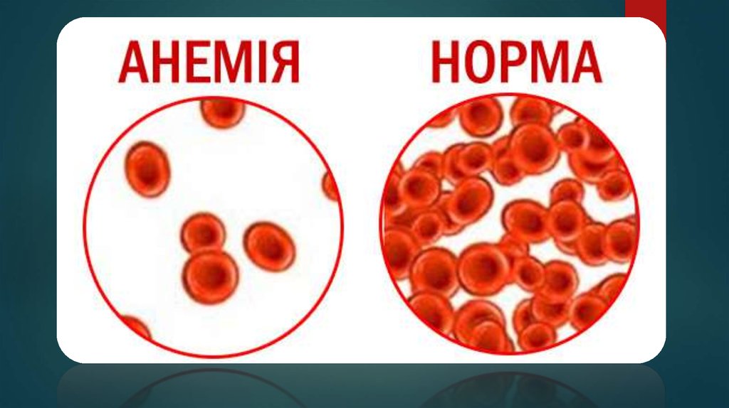 Анемия картинки для презентации