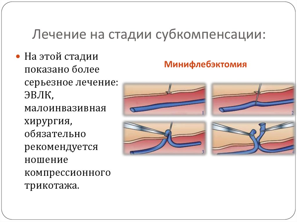 Радиочастотная коагуляция вен нижних конечностей