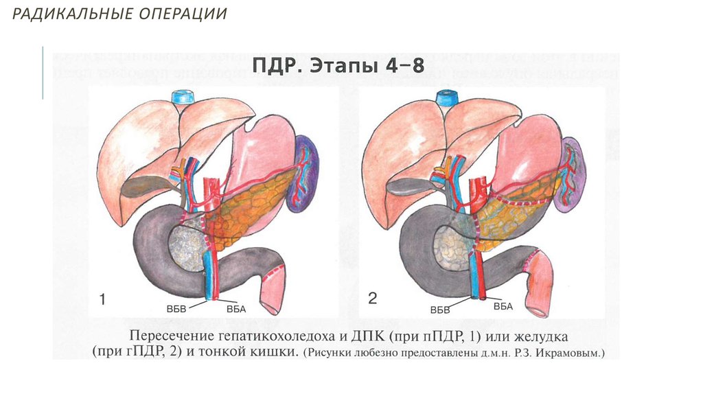 Операция пдр схема