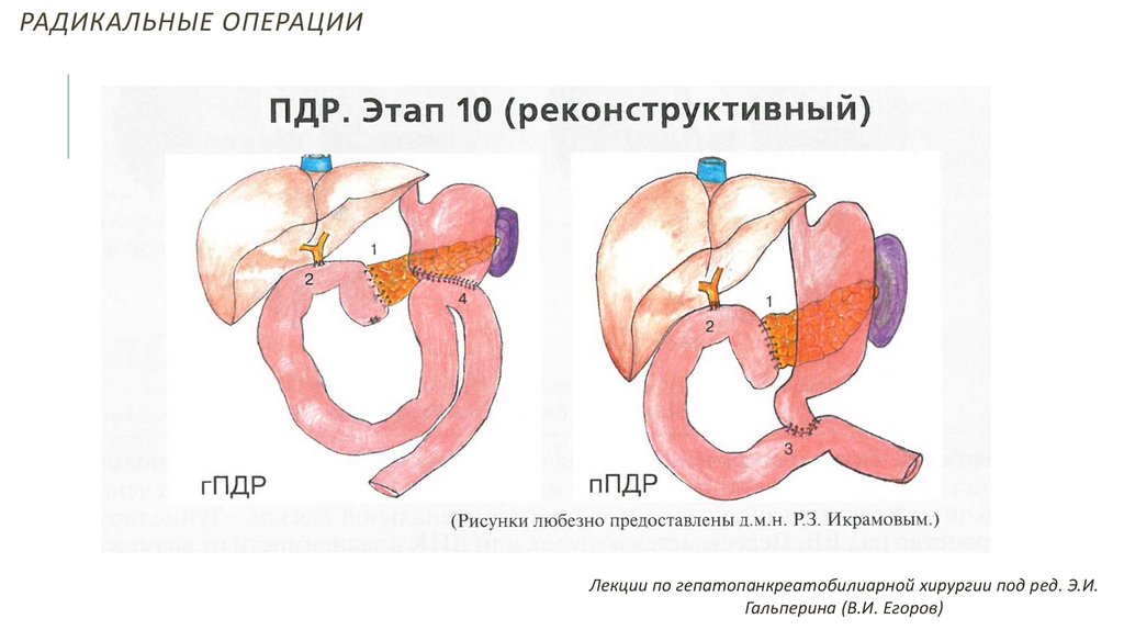 Панкреатодуоденальная резекция схема операции