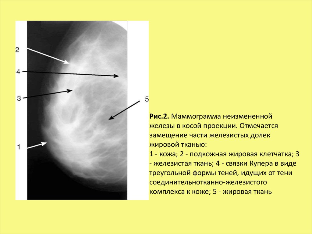 Жировой перестройки. Фиброзно жировая ткань при маммографии. Маммография снимки фиброзно-жировая инволюция. Жировая инволюция молочных желез маммография. Железистая и жировая ткань молочных желез на УЗИ.