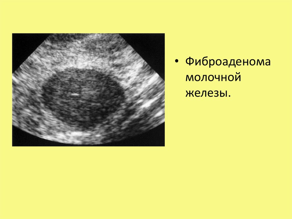 Фиброаденомы молочных желез. Фиброаденома молочной. Фиброаденома в молочной железе. Структура фиброаденомы молочной железы.