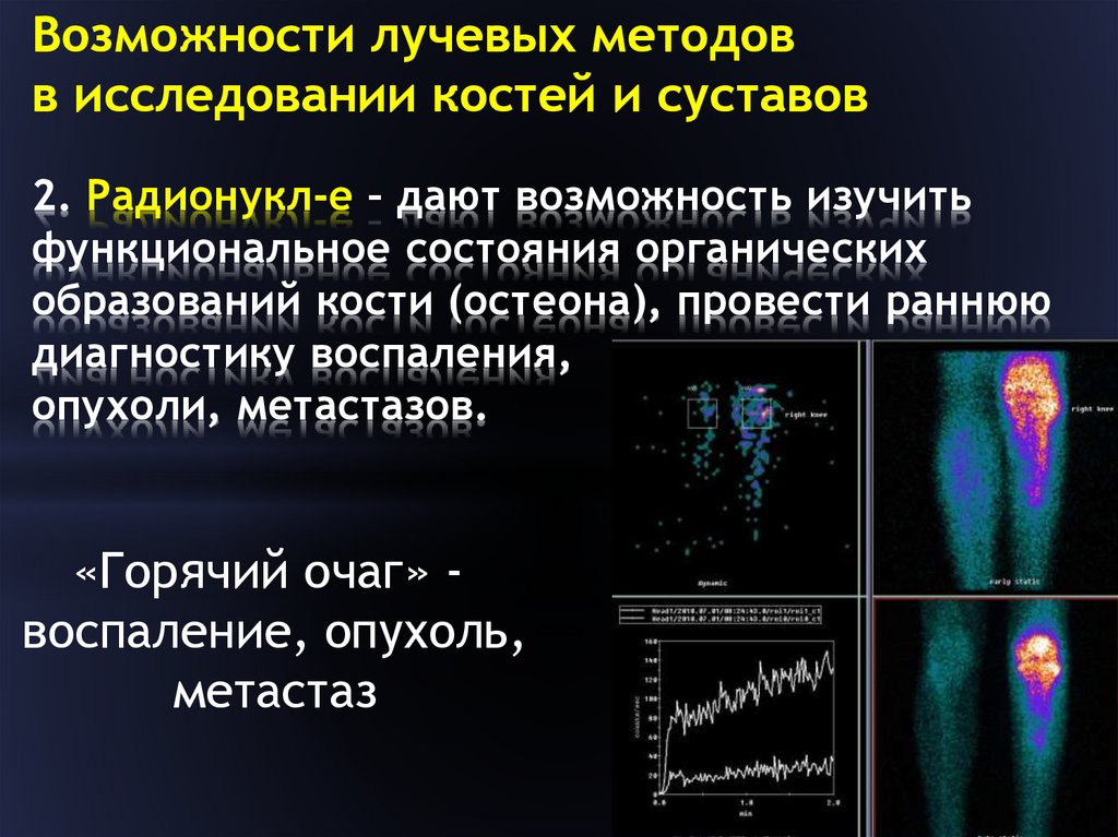 Методы лучевой диагностики. Радионуклидный метод лучевого исследования. Лучевые методы исследования локомоторного аппарата. Методика исследования костно-суставной системы.. Методы лучевой диагностики костно-суставной системы.