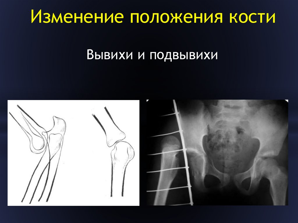 Подвывих. Вывих опорно двигательного аппарата. Подвывих четырехугольного хряща.