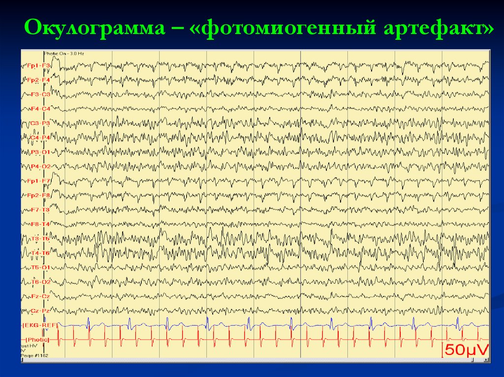Артефакты ЭЭГ. Артефакт моргания на ЭЭГ. ЭЭГ ребенка артефакты. Кожно гальванические артефакты на ЭЭГ.