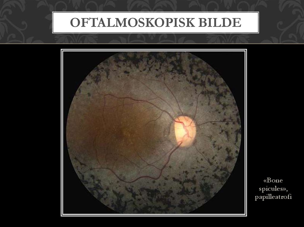 Oftalmoskopisk bilde