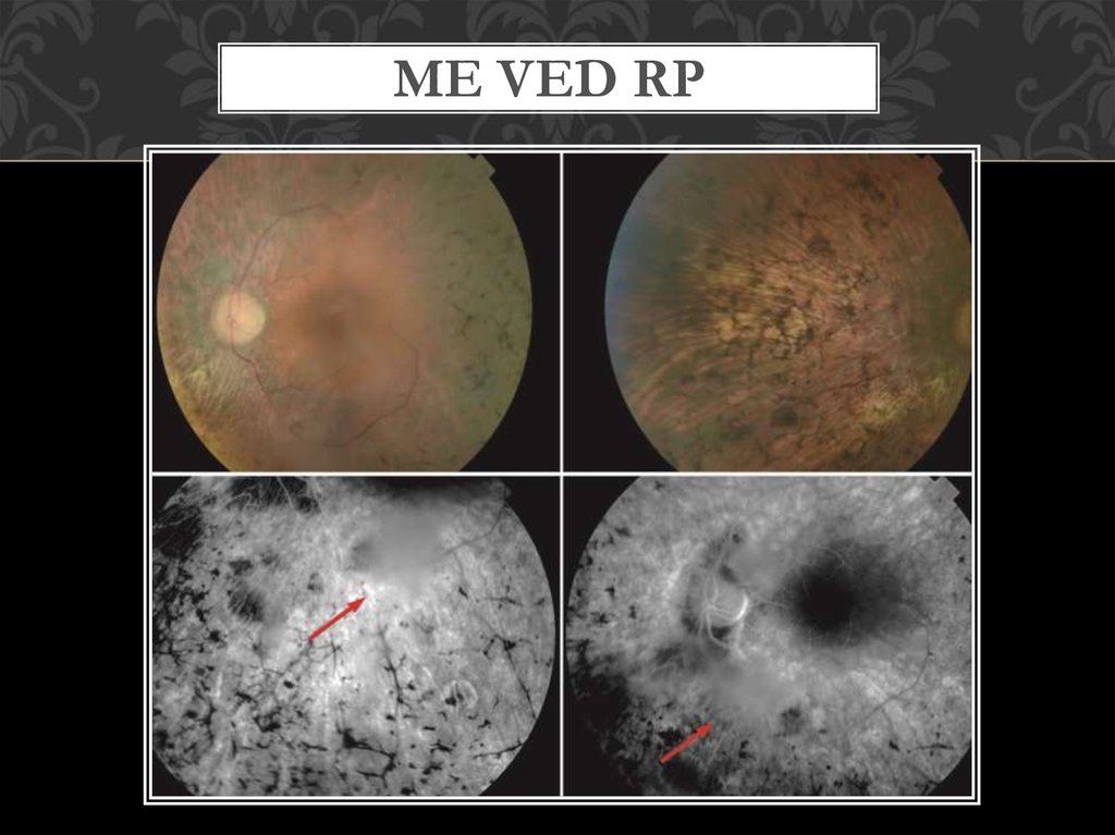 ME ved RP