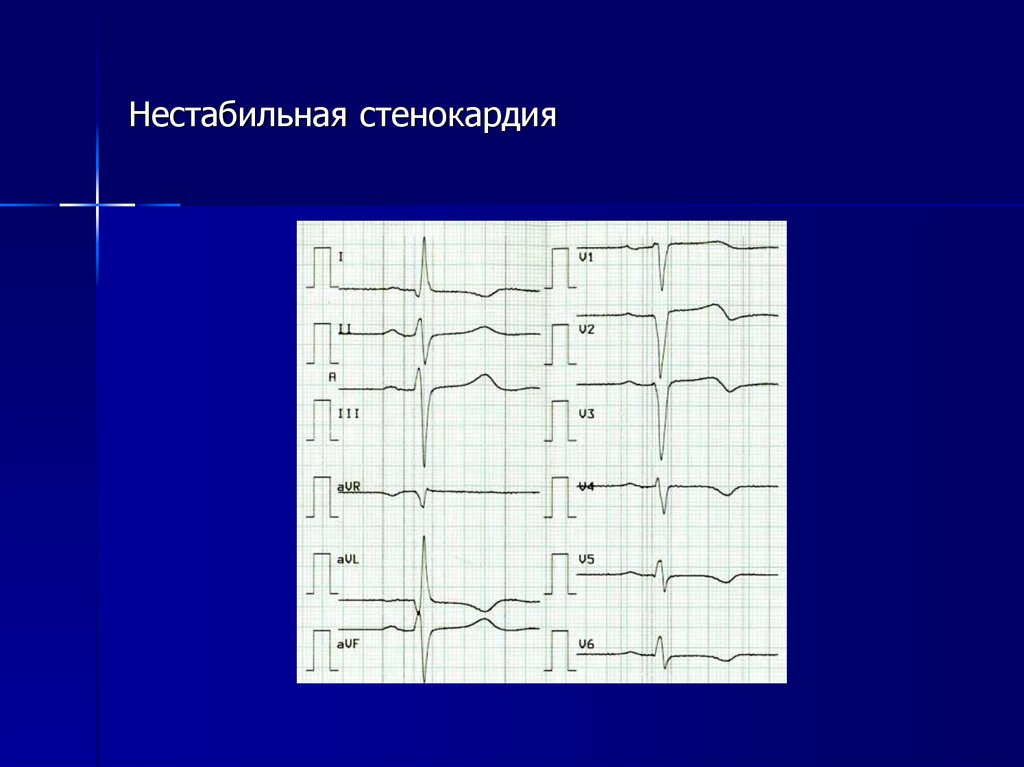 Нестабильная стенокардия