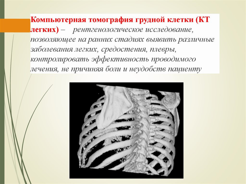 Кт клетки. Компьютерная томограмма грудной клетки. Компьютерная томография ребер грудной. Кт ребер грудной клетки.