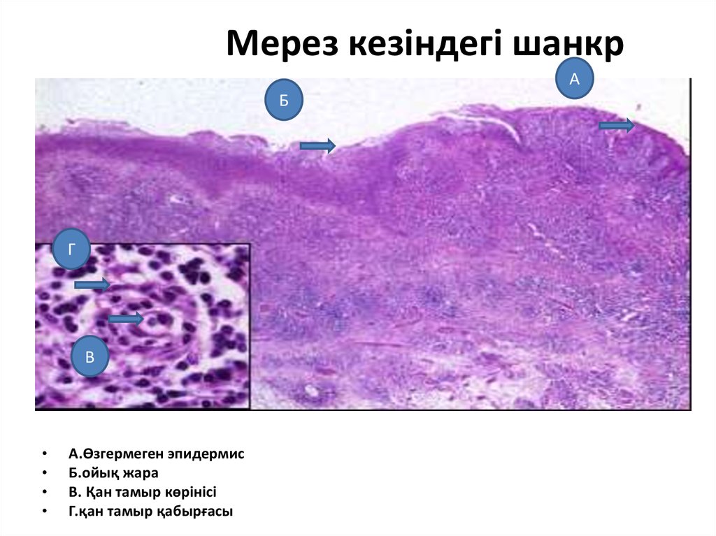 Мерез ауруы презентация